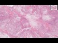 Pleomorphic Adenoma Straight Forward Example 