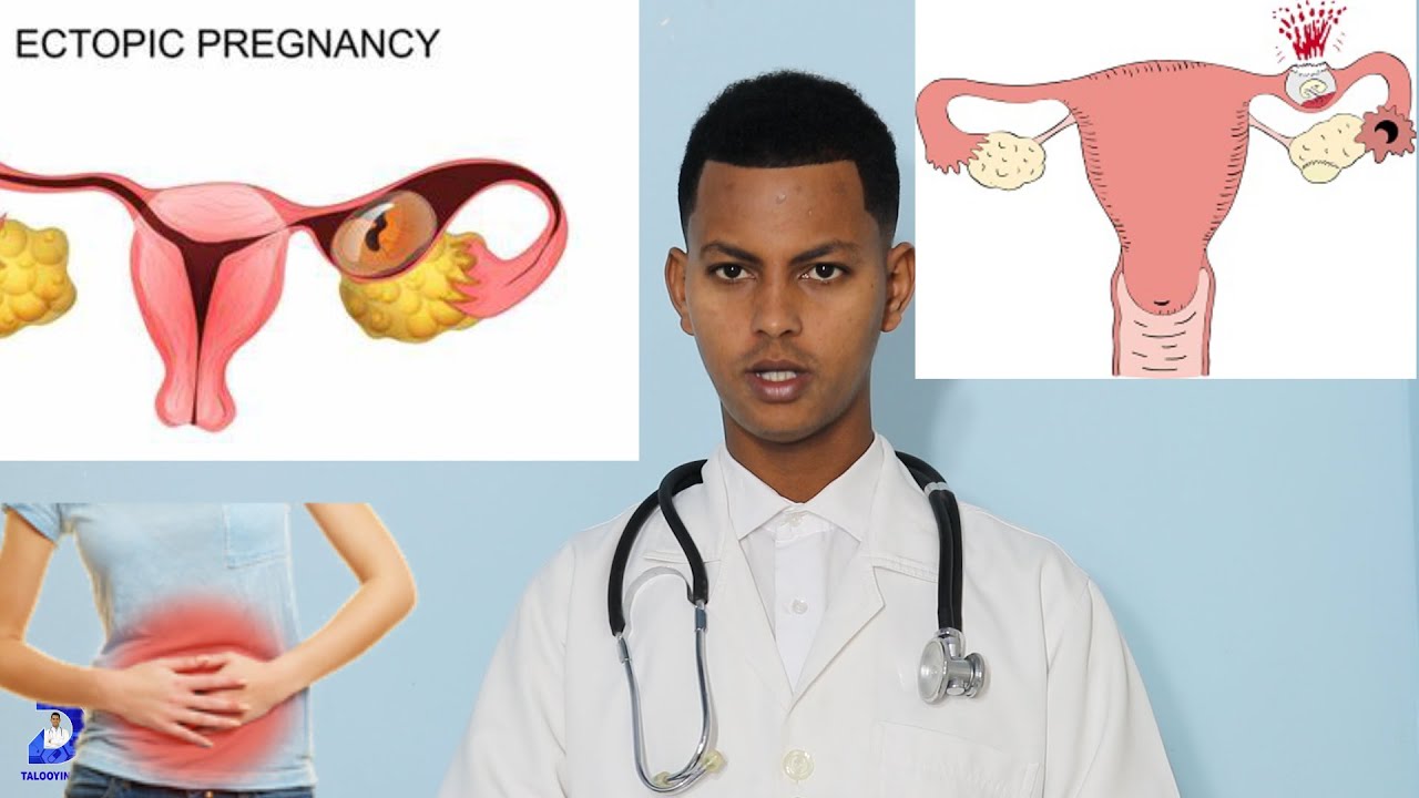 UURKA KU SAMEESMO MEEL KA BAXSAN MINKA (ECTOPIC PREGNANCE).