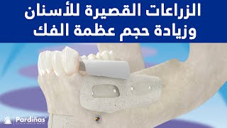 © الزراعات القصيرة للأسنان وزيادة حجم عظمة الفك
