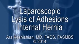 Laparoscopic Lysis of Adhesions - Internal Hernia