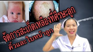 จัดการสะเก็ดเหลืองที่ศีรษะ คิ้ว ใบหน้าลูก  สาเหตุและการดูแล #ต่อมไขมันอักเสบในทารก #ไขมันที่ศรีษะลูก