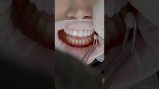 Incredible Transformation With Porcelain Veneers