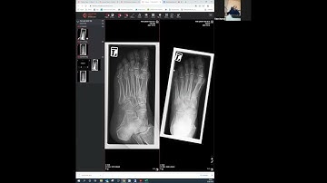 GLEAMERxCMRad Webinar: