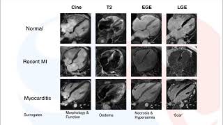 Sam Mohiddin developing pathways for myocarditis