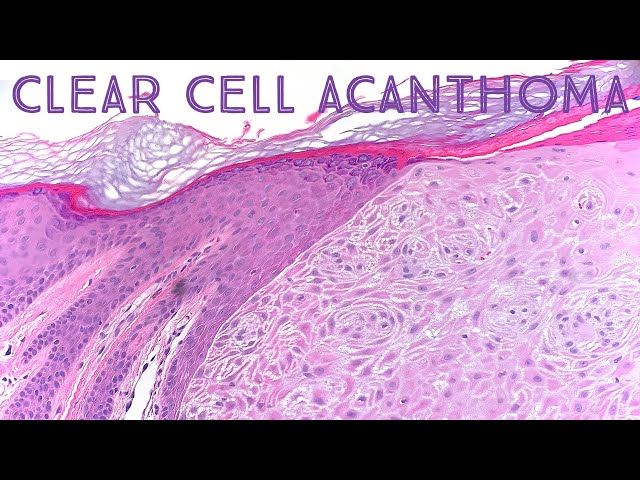 Clear Cell Acanthoma: Dermpath in 5 Minutes (pathology dermatology dermatopathology) class=