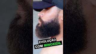 Evolução Minoxidil - 8 Meses De Tratamento