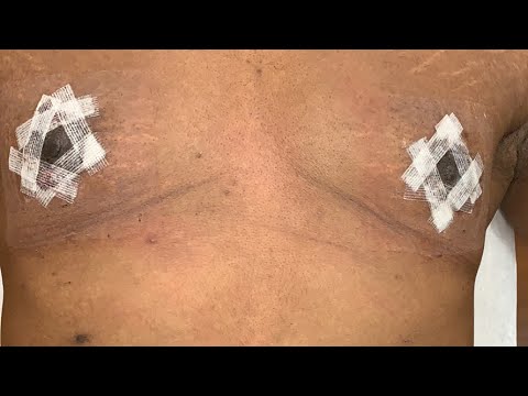 live-gynecomastia-surgery-(nipple-lift)---3-day-postoperative-follow-up-on-27-year-old-male-from-ny