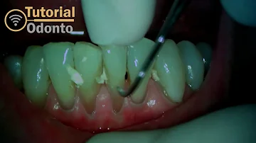 O que é raspagem supra gengival?