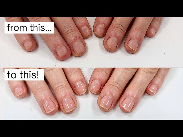 Health From Nails: 10 Fingernail Problems to Watch for | SELF