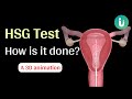 What is hsg test and how is it done a 3d medical animation