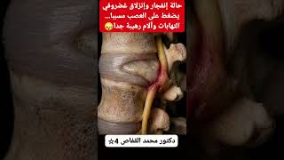 إنفجار وإنزلاق غضروفي وضغط على العصب #shorts #viralvideo #foruyou
