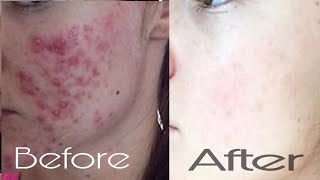 100% Permanent Acne Removal Treatment in urdu/hindi