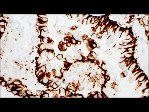 Video: NSCLC-biopsioiden Automaattinen Kuva-analyysi Anti-PD-L1-hoidon Vasteen Ennustamiseksi