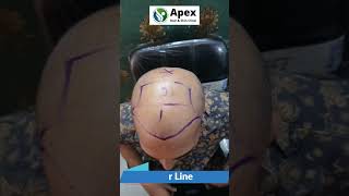 Best Hair Transplant in Delhi NCR | Apex Hair Transplant Clinic Noida | #shorts #hairtransplant