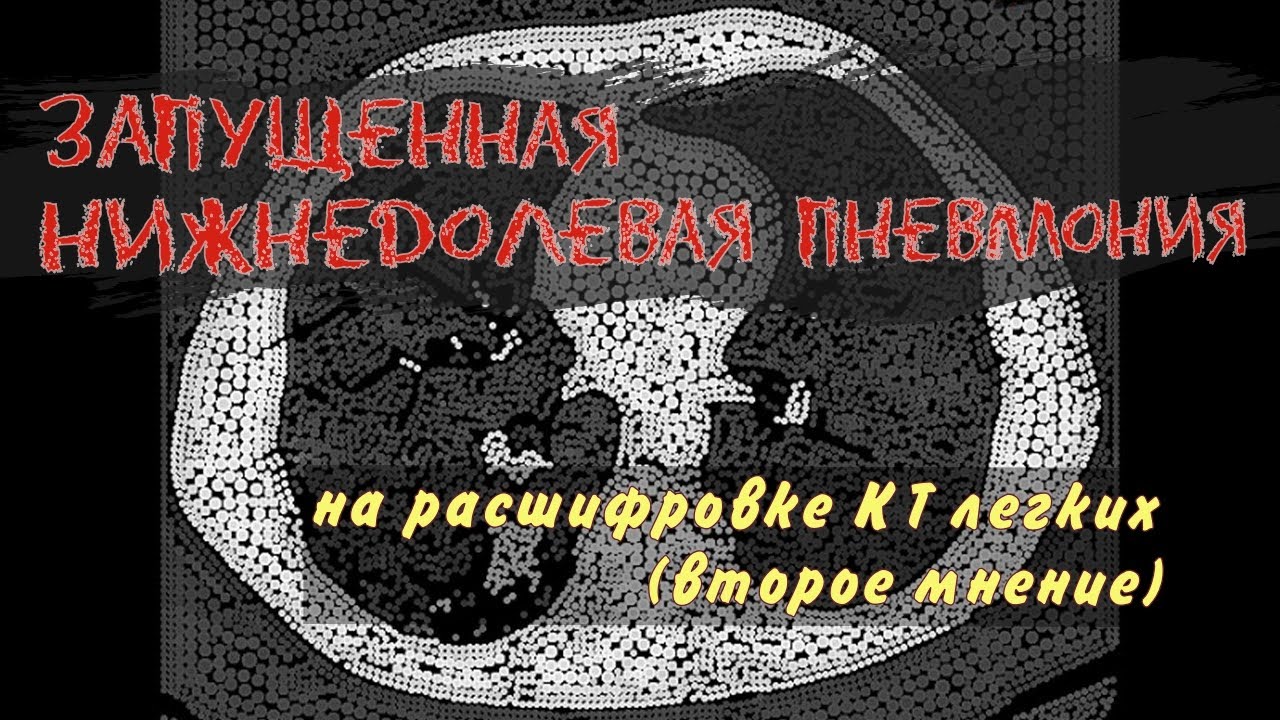 ХРОНИЧЕСКИЙ БРОНХИТ, пневмофиброз и правосторонняя НИЖНЕДОЛЕВАЯ ...