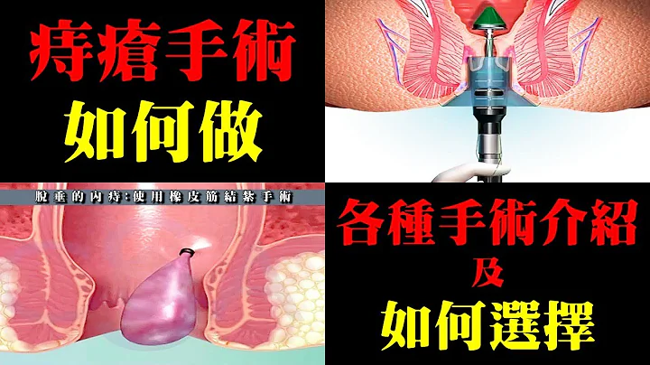 痔疮的手术如何做？各种手术介绍及如何选择｜许原彰医师 - 天天要闻