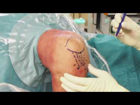Video: Artroscopia Del Ginocchio