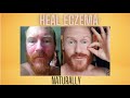 ECZEMA Healing ADVICE for a Struggling / Suffering College Student