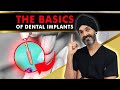 Dental Implants 101 - What you need to know