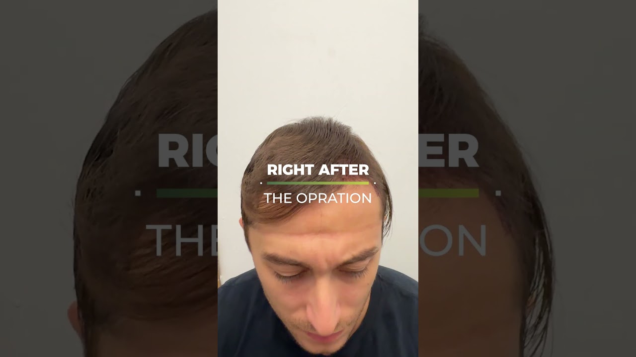 No Shave, Instant Confidence: Long Hair FUE Transformation Revealed!