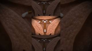 IUD Explained : The Most Effective Birth Control || 3d animation || #viral #coppertube #anatomy