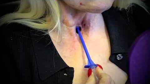 Use of Provox Flush - how to use the Flush to clean a voice prosthesis (TEP)