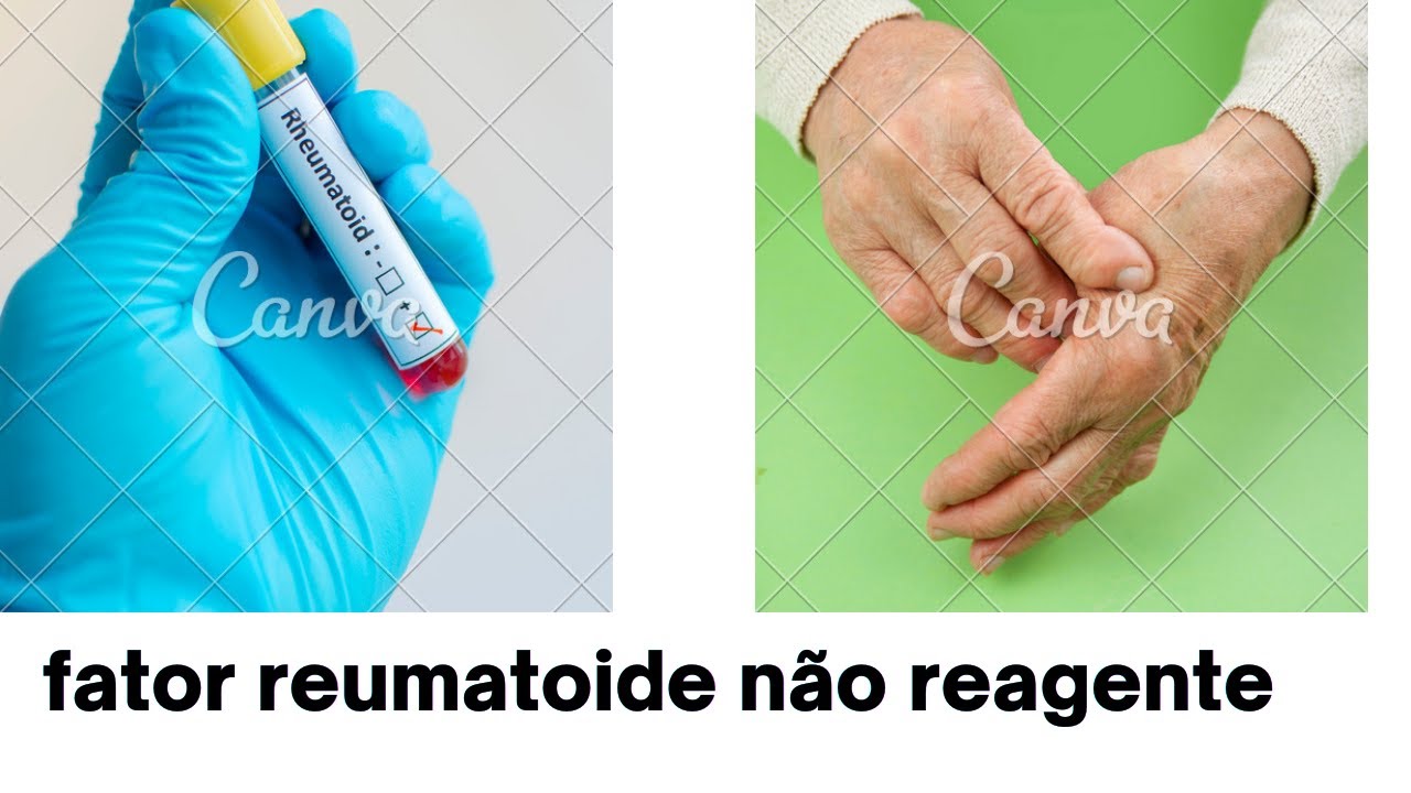 fator reumatoide não reagenteARTRITE MUITO ALÉM DAS JUNTAS YouTube fator reumatoide não reagenteARTRITE MUITO ALÉM DAS JUNTAS YouTube