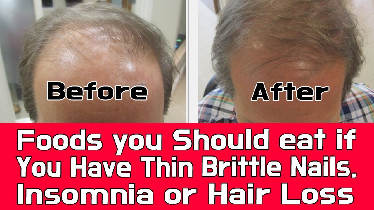 Foods You Should Eat If You Have Thin Brittle Nails Insomnia Or