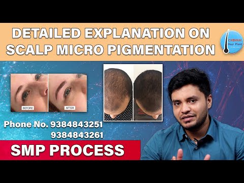 What is Scalp pigmentation ? /Doctor Interview/ Chennai Hair Plant / Best  Hair Transplant Clinic - YouTube