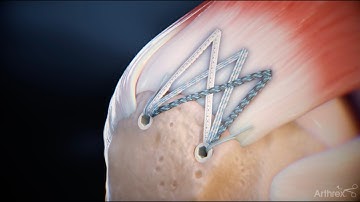 Delaminated Rotator Cuff Repair Surgical Technique Animation