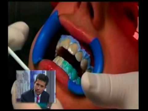 Clinica Dental Cuevas: Blanqueamiento dental ( 1 P...
