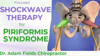 Shockwave for Piriformis Syndrome | Sciatica Relief from ESWT