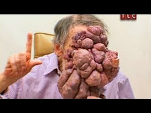 Мальчик отказался от операции по удалению опухоли чтобы сохранить свою улыбку
