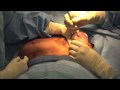 Breast Lift with Breast Implants | Live Cosmetic Surgery Video