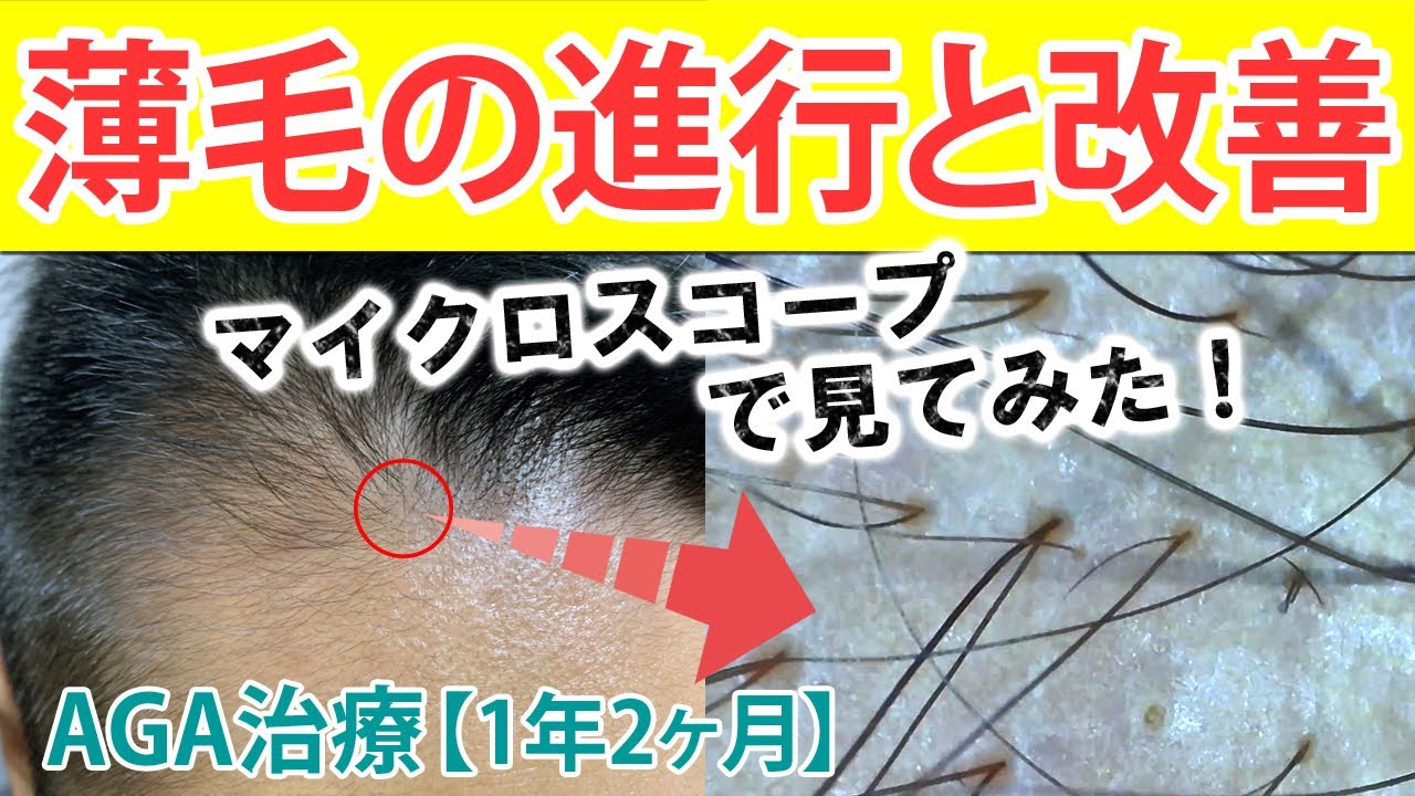 マイクロスコープで見てみた 薄毛の進行と改善 Aga治療 薄毛治療体験レポート1年2ヶ月目 薄毛に悩む30代40代男性向け Youtube マイクロスコープで見てみた 薄毛の進行と改善 Aga治療 薄毛治療体験レポート1年2ヶ月目 薄毛に悩む30代40代男性向け Youtube