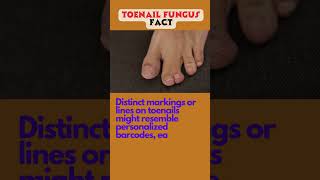 Natural Remedy: Toe Nail Fungus Cure onychomycosis howtocurenailfungus fungalinfection