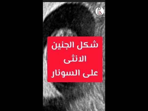 شكل الجنين الانثى على السونار