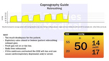Capnography Waveforms: Rebreathing