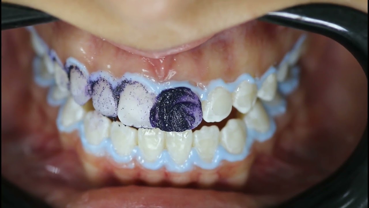 Microabrasão com Opalustre (Ultradent)