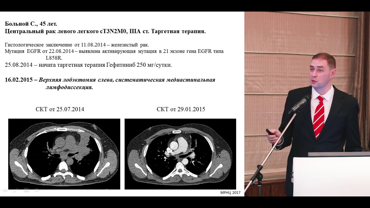 Нужна ли больным с резектабельным НМРЛ неоадъювантная химиотерапия ...