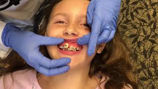 5th Braces Visit || Getting BRACES Put On 😬