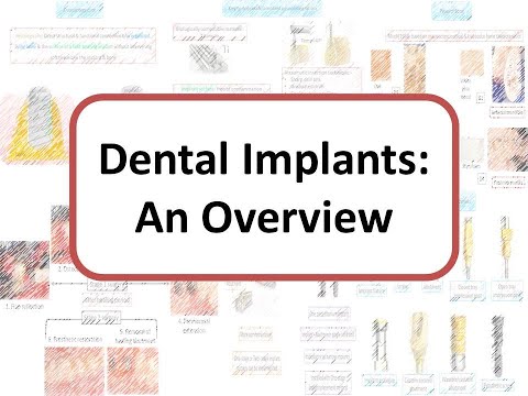 Wideo: Implant śródkostny: Typy Implantów Dentystycznych I Procedury