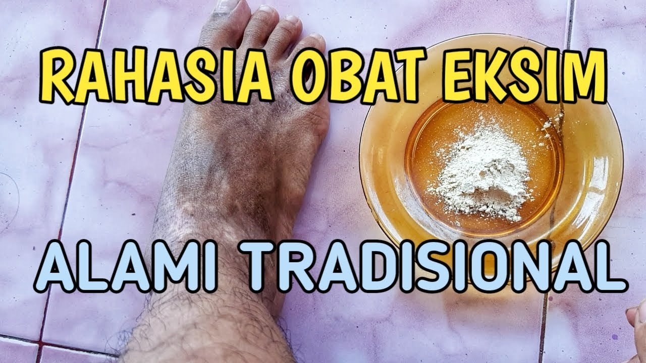 Cara Mengobati Eksim Secara Alami Tradisional 