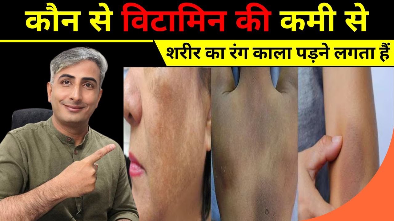 पिगमेंटेशन को जड़ से खत्म करने के उपाए   Get Rid of Hyperpigmentation Naturally   Dr  Manoj Das