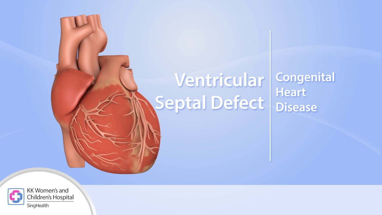 .vsd คือ  2022 Update  Heart Conditions – Ventricular Septal Defect (VSD)