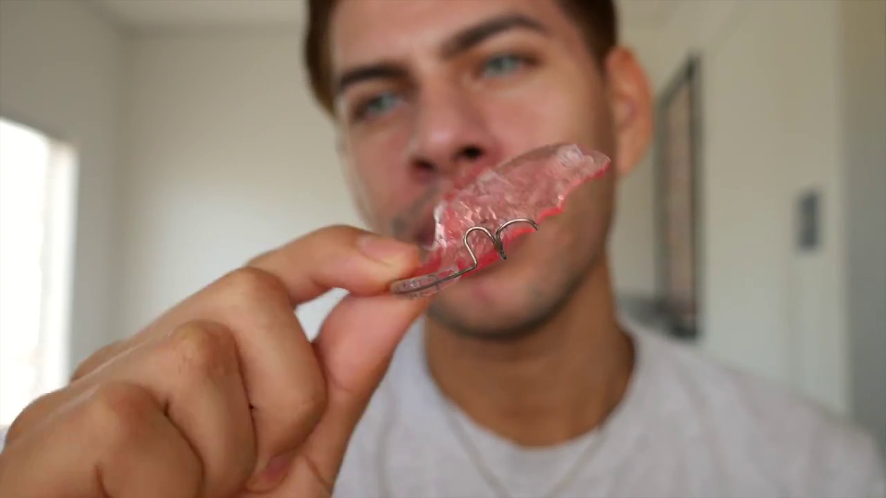 WHY DO I NEED RETAINERS? - YouTube