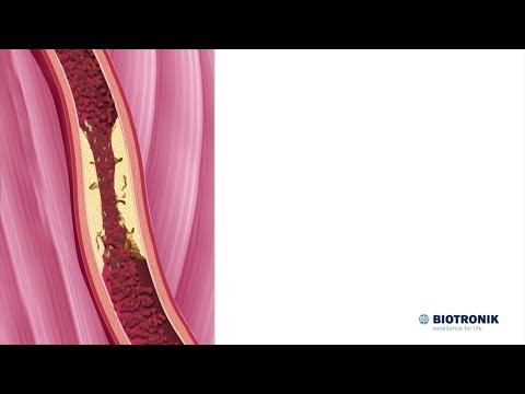 Video: Hva er aterosklerose arteriosclerosis og arteriolosclerosis?