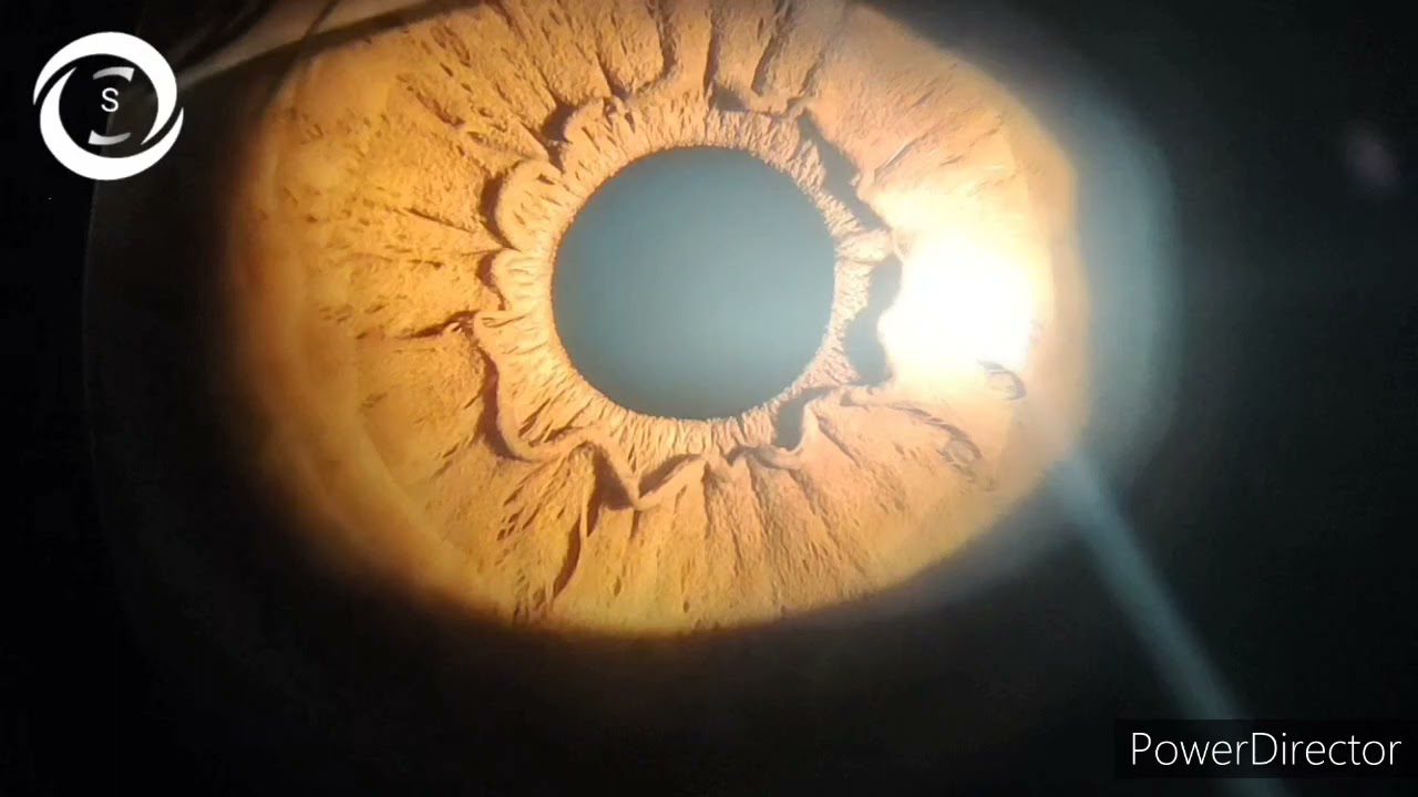 Prominent iris collarette