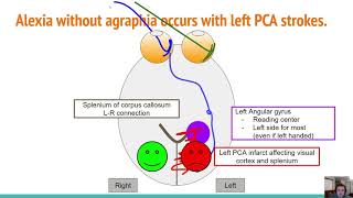 Strokes Alexia Without Agraphia