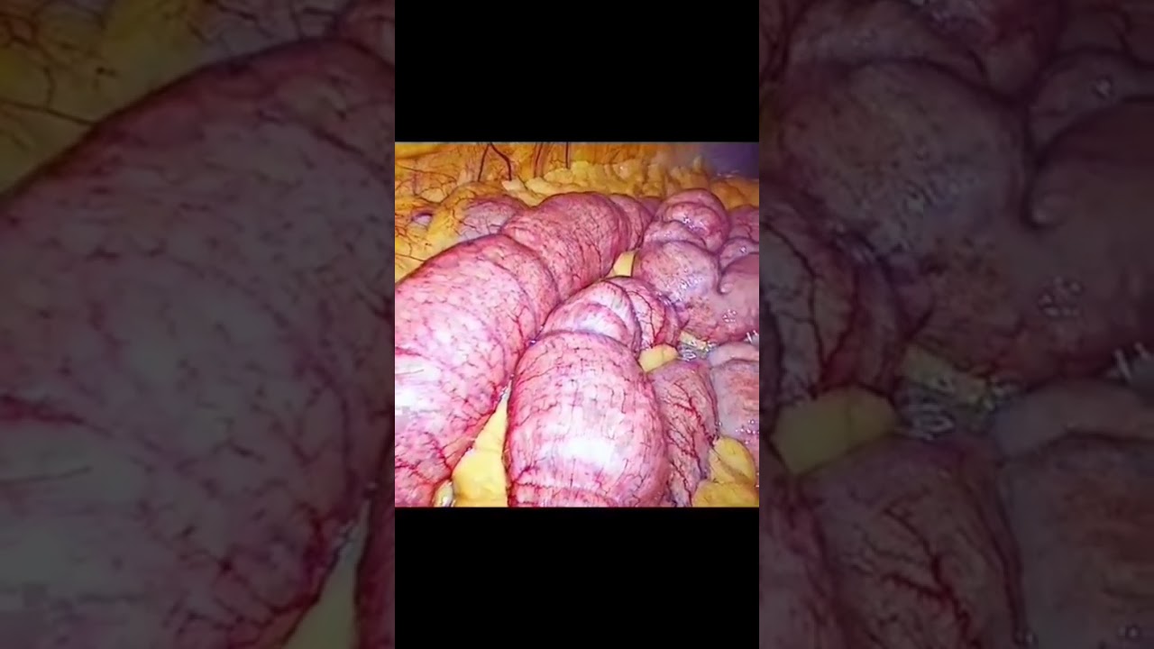 حركة الأمعاء الدقيقة..فيديو يستحق المشاهدة